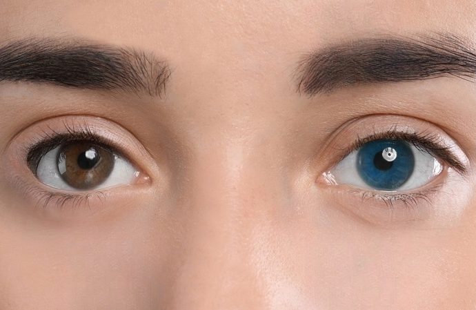 Central Heterochromia