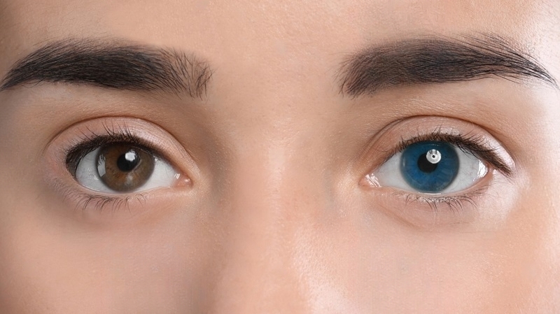 Central Heterochromia