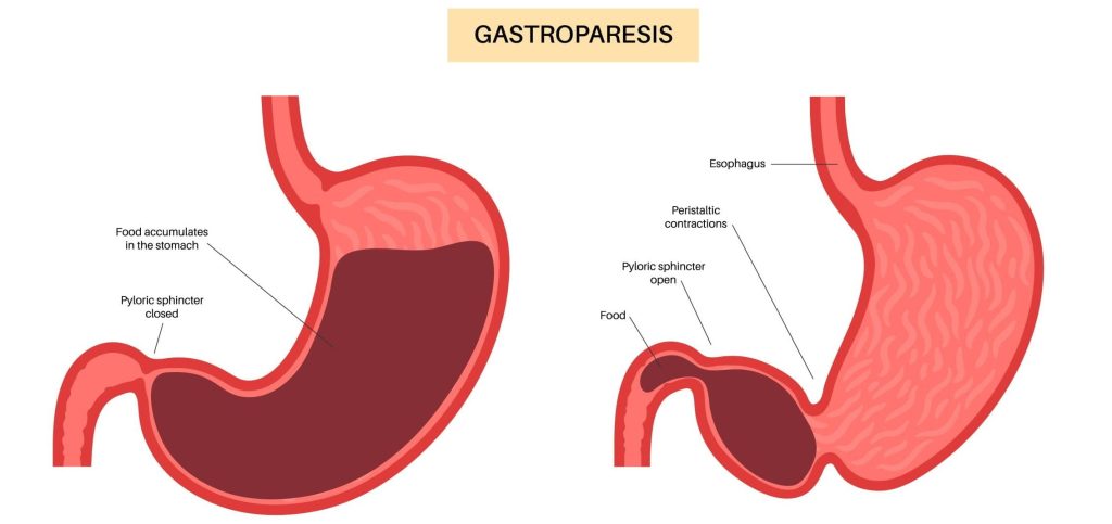 Gastroparesis