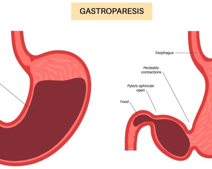 Gastroparesis