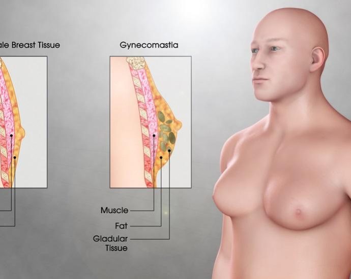 Gynecomastia