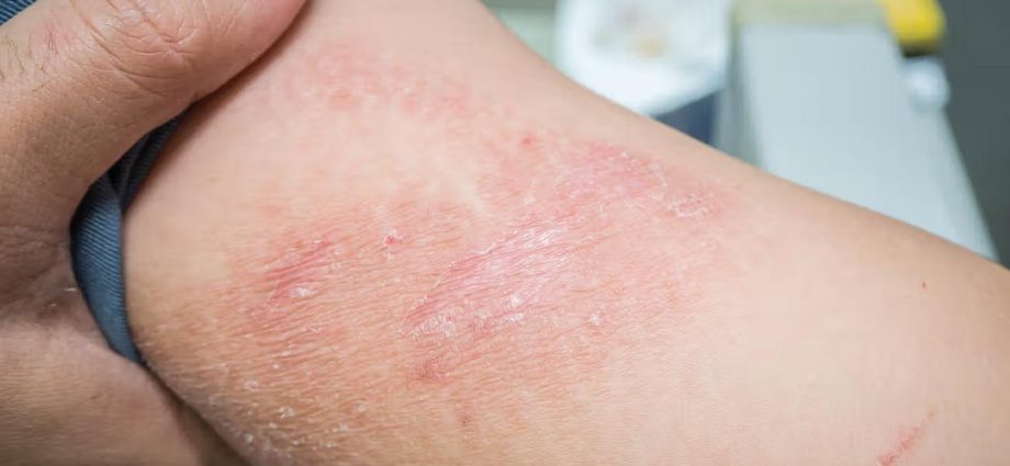 Allergic Dermatitis