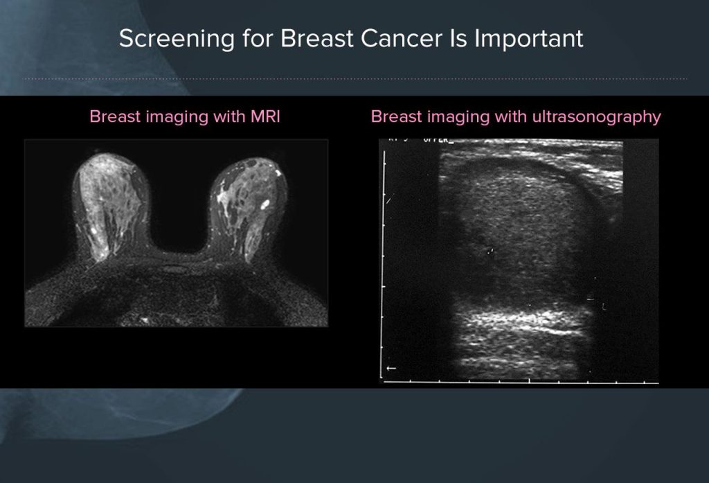 Breast Cancer Screening Guidelines and Recommendations