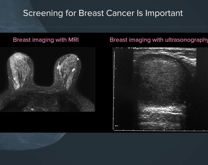 Breast Cancer Screening Guidelines and Recommendations