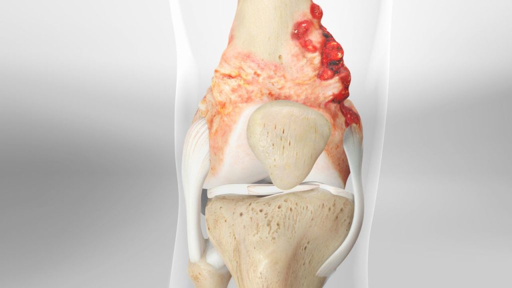 Osteosarcoma