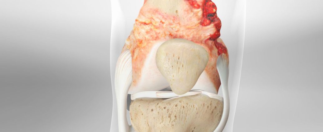 Osteosarcoma