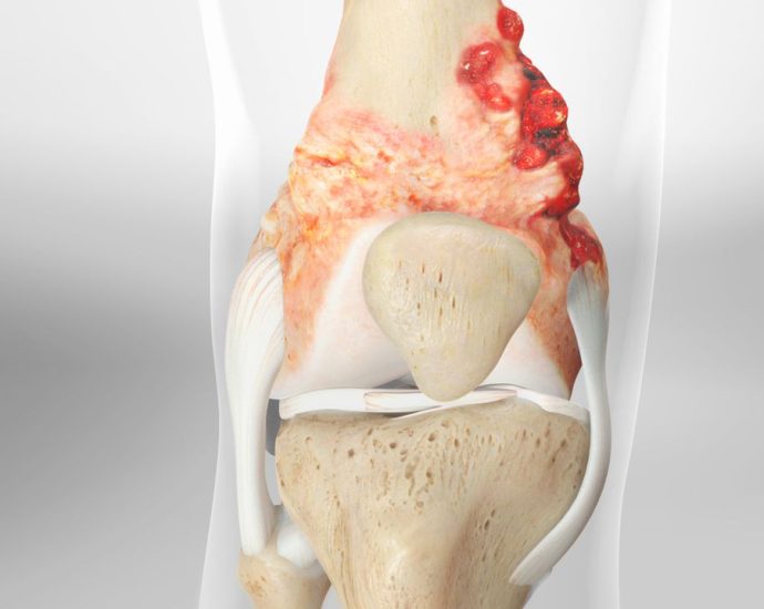 Osteosarcoma