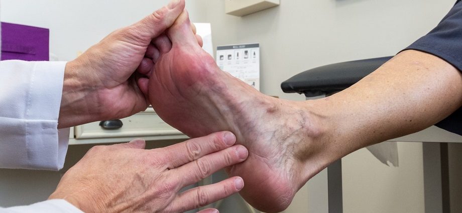 Plantar Fasciitis