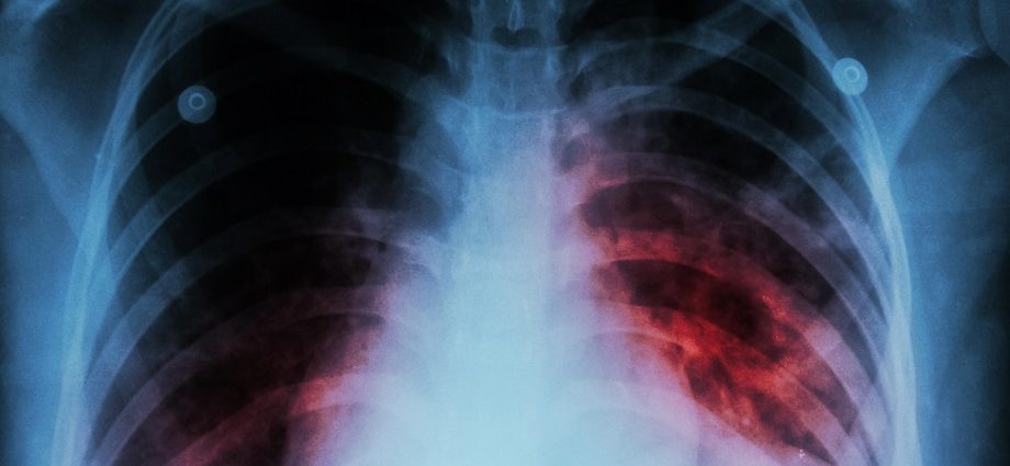 Tuberculosis