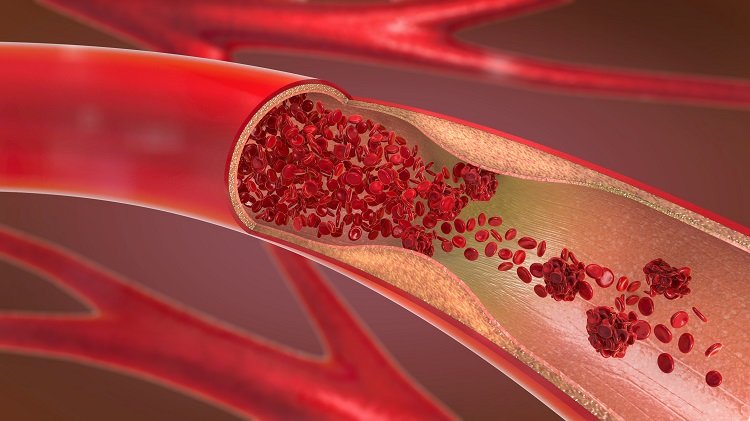 Catheterization What It Is And What It Is For