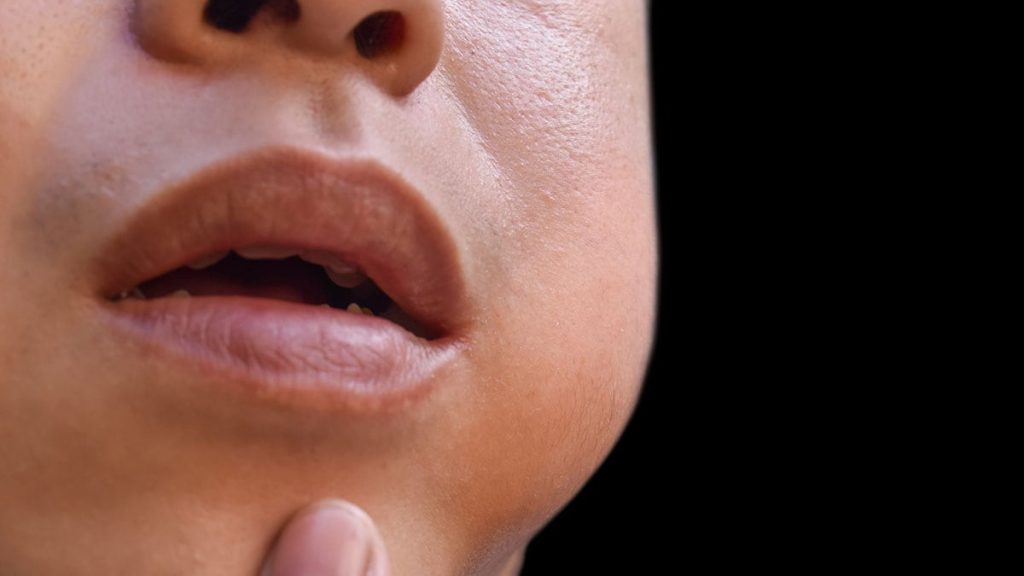 Mumps (Parotitis) What It Is, Causes, Symptoms and Treatment