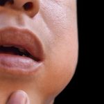 Mumps (Parotitis) What It Is, Causes, Symptoms and Treatment