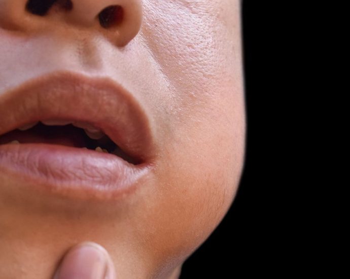 Mumps (Parotitis) What It Is, Causes, Symptoms and Treatment