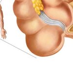 Appendicitis What Is It, Causes, Symptoms, and Treatment