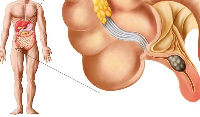 Appendicitis What Is It, Causes, Symptoms, and Treatment