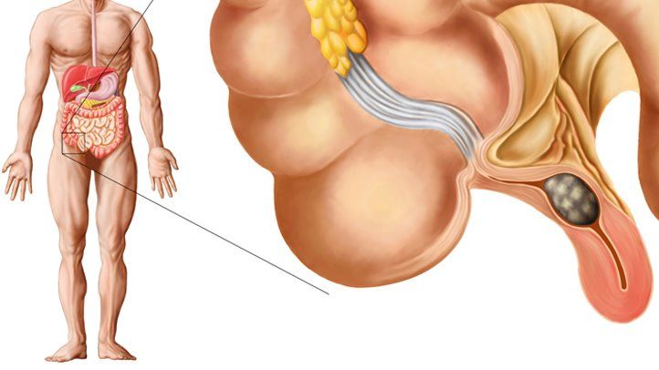 Appendicitis What Is It, Causes, Symptoms, and Treatment