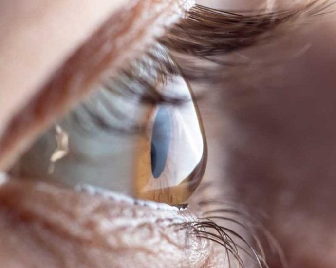 Astigmatism What Is It, Causes, Symptoms and Treatment