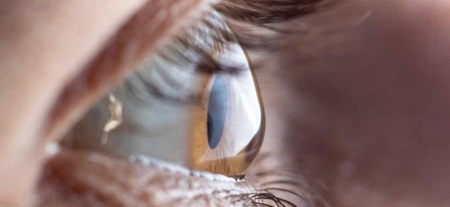 Astigmatism What Is It, Causes, Symptoms and Treatment