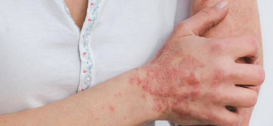 Leukemia What Is It, Causes, Symptoms and Treatment
