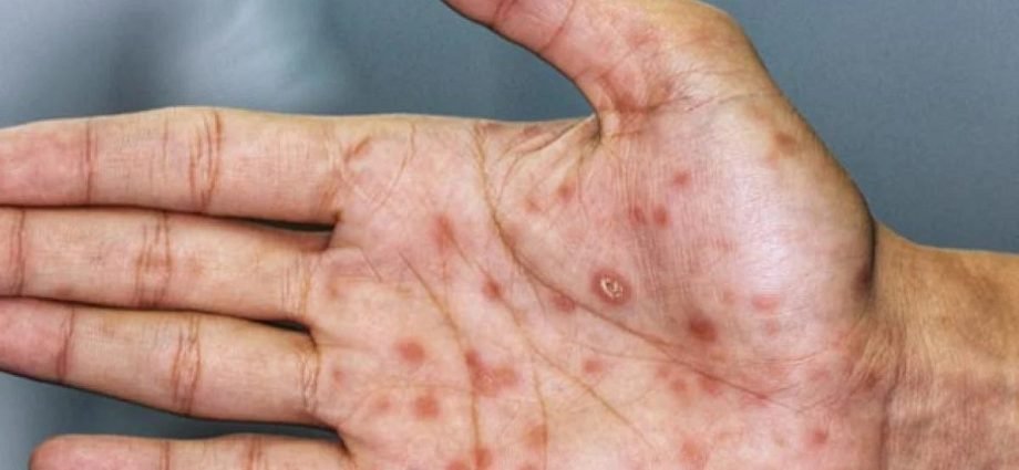 Syphilis What Is Is, Causes, Symptoms and Treatment