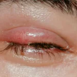 Stye What It Is, Causes and Symptoms