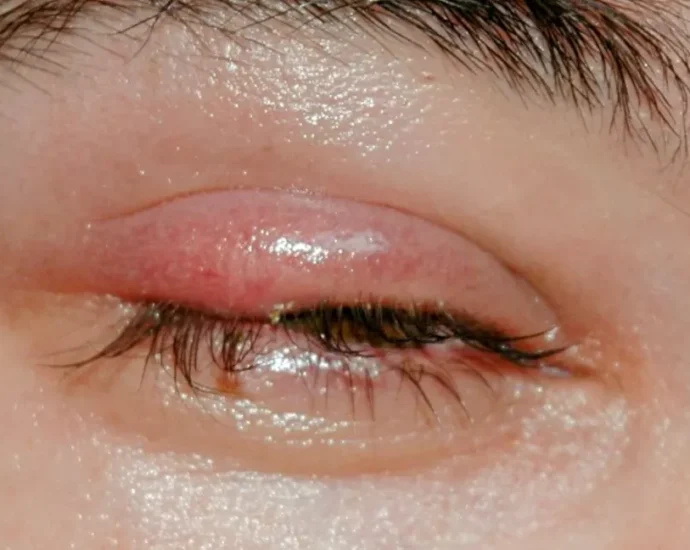 Stye What It Is, Causes and Symptoms