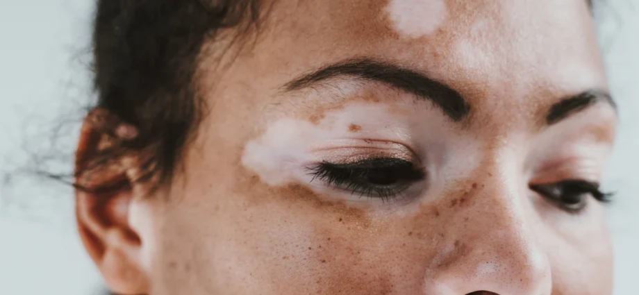 Vitiligo What Is It, Causes, Symptoms and Treatment