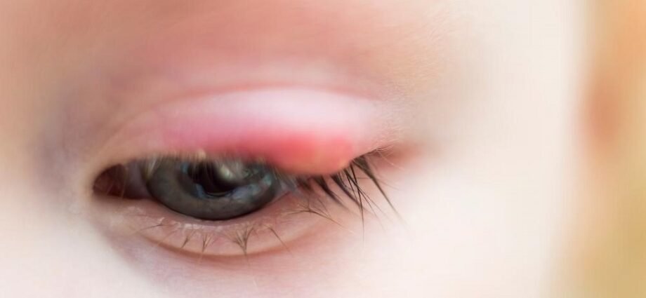 How to Cure A Stye Quickly and Easily