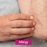 Allergies Treatments, Symptoms, and Causes