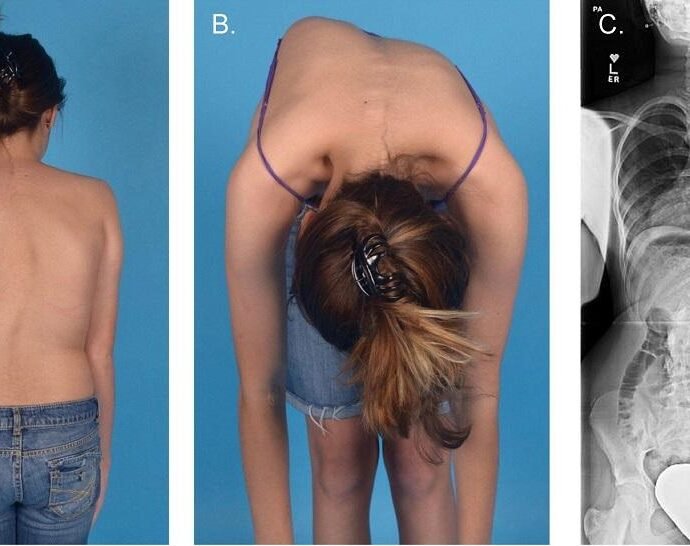 Scoliosis What is, Causes, Symptoms, and Treatment