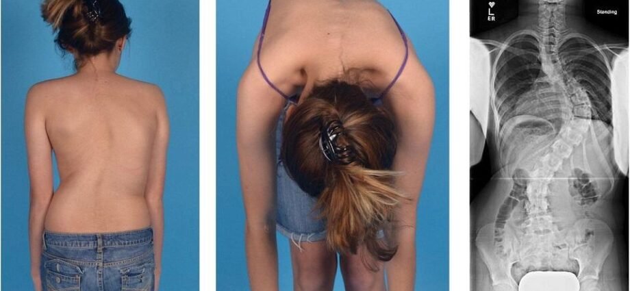 Scoliosis What is, Causes, Symptoms, and Treatment