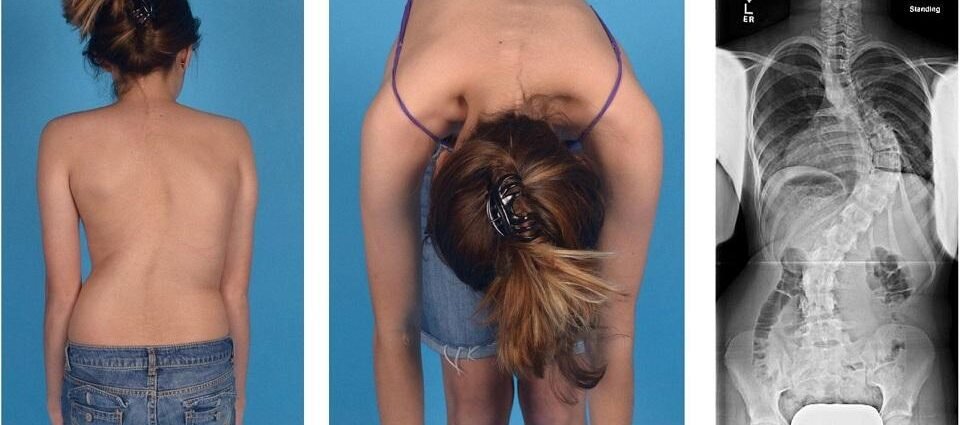 Scoliosis What is, Causes, Symptoms, and Treatment