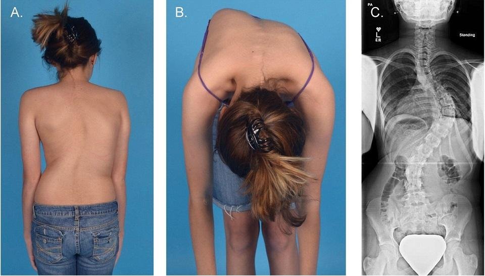 Scoliosis What is, Causes, Symptoms, and Treatment