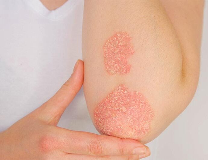 What is Psoriasis All the information you need to know