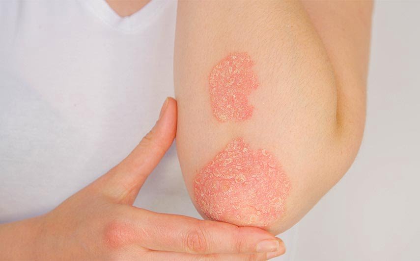 What is Psoriasis All the information you need to know