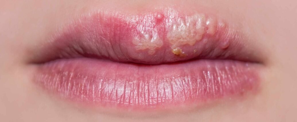 Lip Herpes and How to Prevent their Appearance