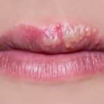 Lip Herpes and How to Prevent their Appearance