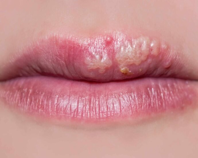 Lip Herpes and How to Prevent their Appearance