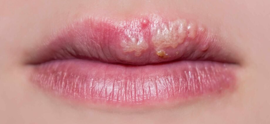 Lip Herpes and How to Prevent their Appearance