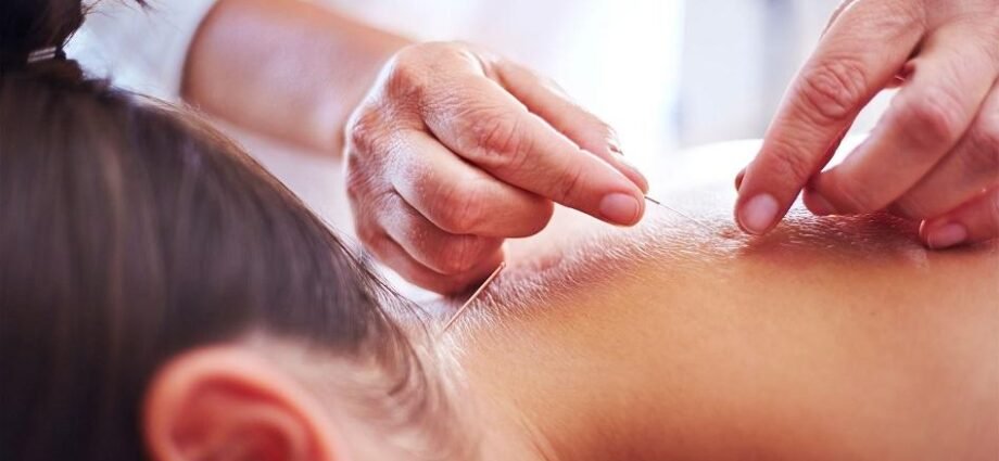 Acupuncture