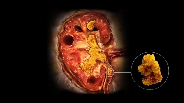 Nephrolithiasis (Kidney Stones)