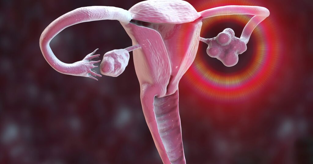 Polycystic Ovary Syndrome (PCOS)