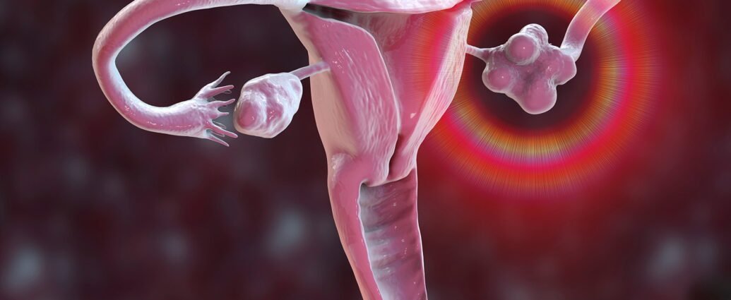 Polycystic Ovary Syndrome (PCOS)