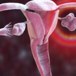 Polycystic Ovary Syndrome (PCOS)