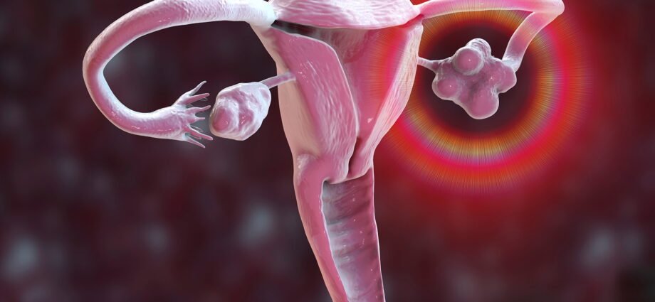 Polycystic Ovary Syndrome (PCOS)