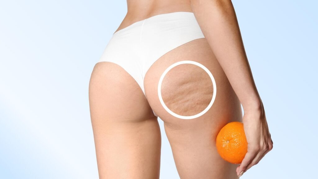 Cellulite