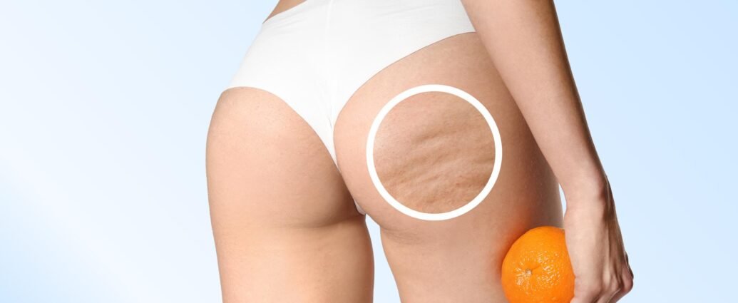 Cellulite