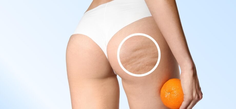 Cellulite