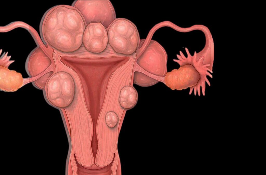 Uterine Fibroids What You Need to Know