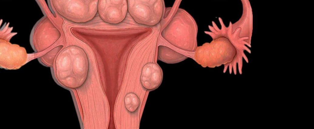 Uterine Fibroids What You Need to Know